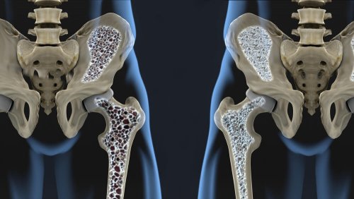 6 dicas para prevenir a osteoporose com a alimentação