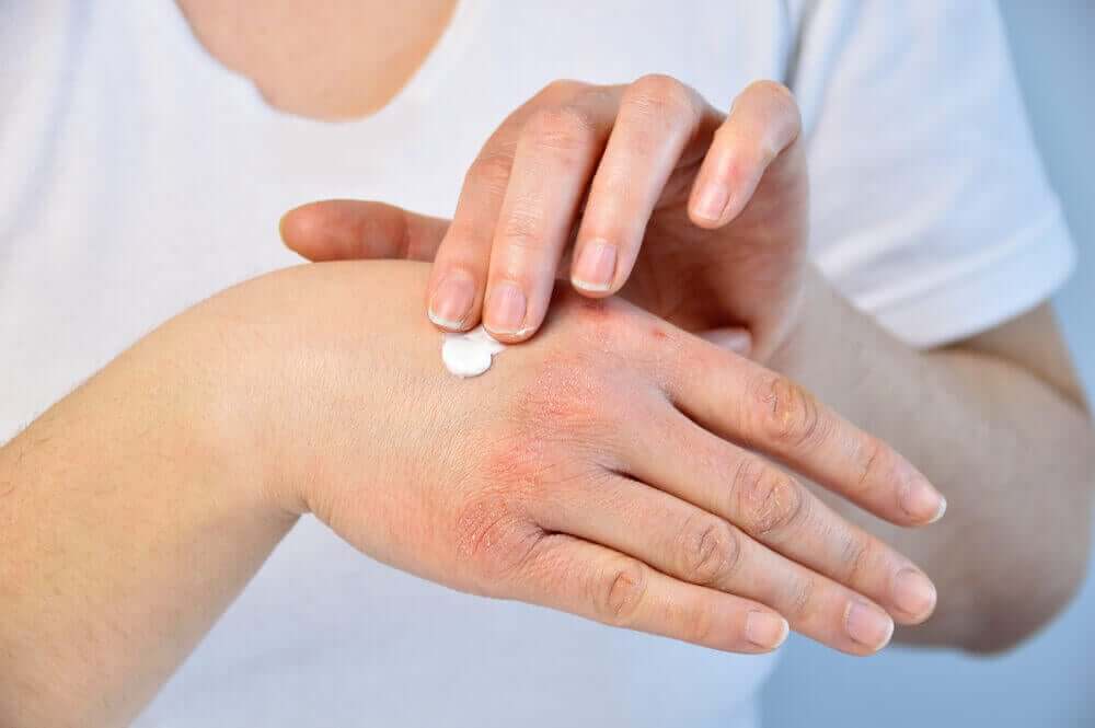 remédios naturais para a psoríase nas unhas