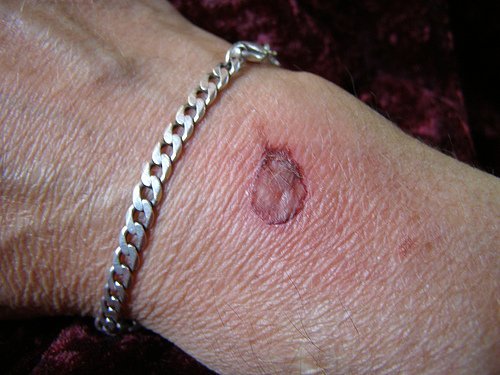 Cicatriz por queimadura