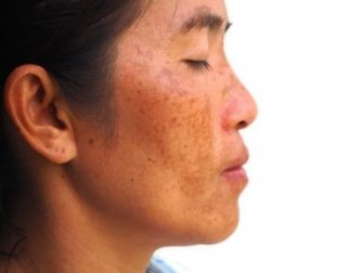 Como fazer um tratamento à base de iogurte, banana e limão para atenuar o melasma