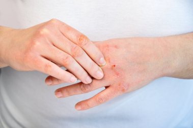 Como cuidar de mãos rachadas: 10 recomendações