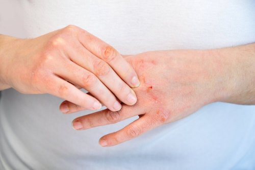 Como cuidar de mãos rachadas: 10 recomendações