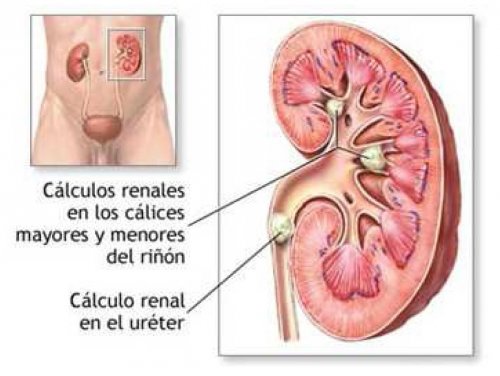 5 bebidas à base de ervas para prevenir pedras nos rins