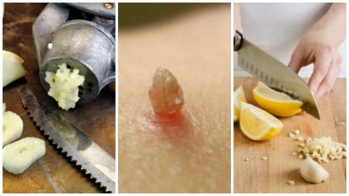 Preparações medicinais para remover as verrugas naturalmente