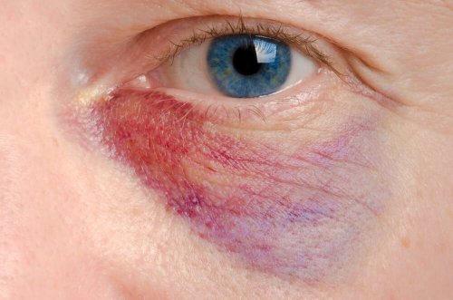 Como aliviar um olho roxo: 6 tratamentos naturais