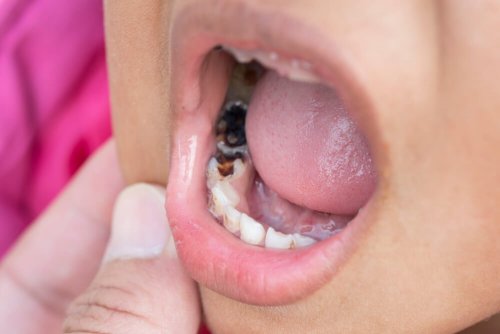 Se seu filho quebrar um dente leve-o para o dentista