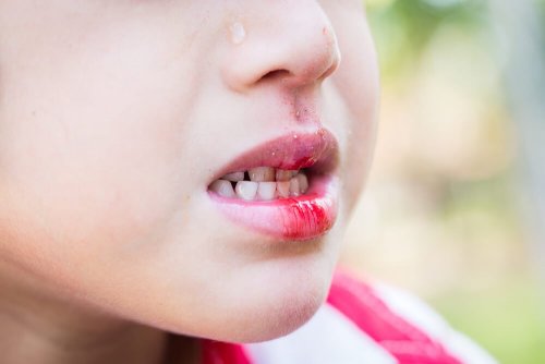 quebrar um dente pode gerar sangramento