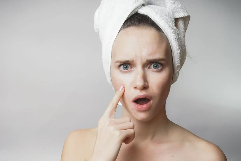 Que no comer para evitar acne