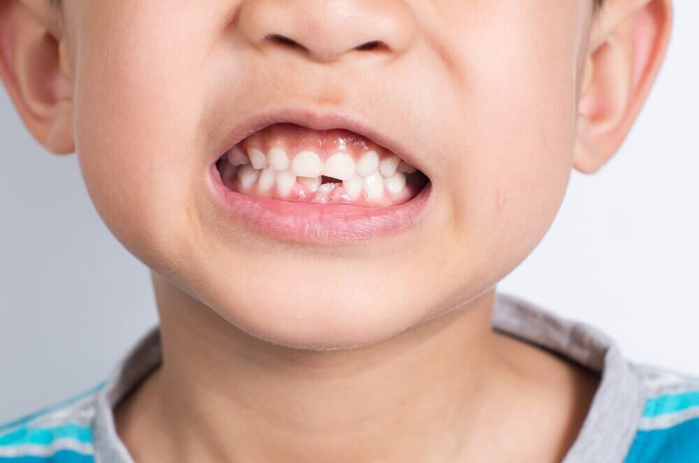 O que fazer se meu filho quebrar um dente?