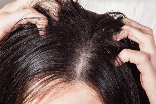 O óleo de menta combate a descamação do couro cabeludo