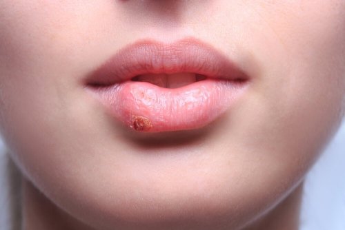 Moça com herpes labial