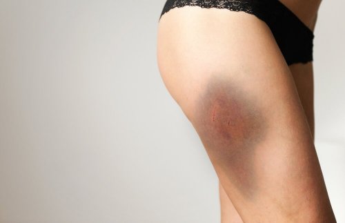 Características dos hematomas