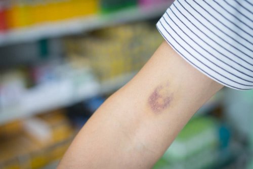 Raios solares e massagens para atenuar os hematomas