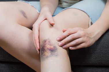 Atenuar os hematomas com 5 soluções naturais