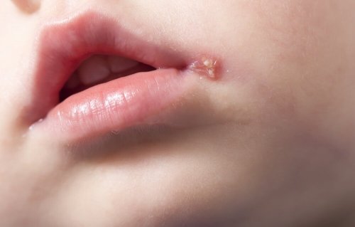 Sintomas do herpes em crianças