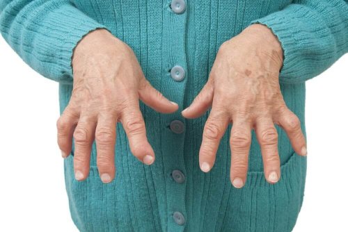 a artrite reumatoide