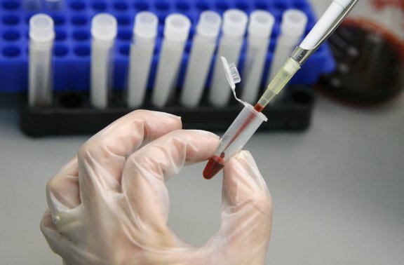 O transplante de células-tronco pode erradicar o HIV