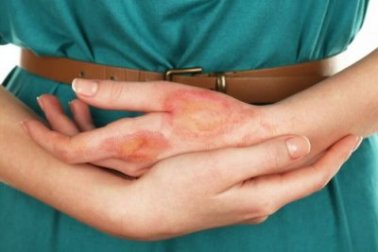 Queimaduras nos dedos: 6 remédios caseiros para aliviar