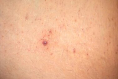 Pernas de morango: causas e tratamentos caseiros