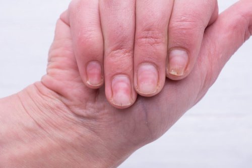 Unhas amareladas? Confira essa solução caseira!