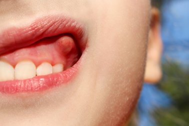 Cure o abscesso dentário com 10 remédios caseiros