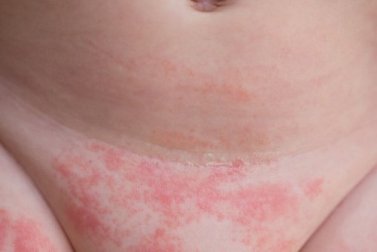 4 dicas para evitar a dermatite de fralda