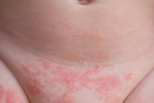 4 dicas para evitar a dermatite de fralda - Melhor Com Saúde