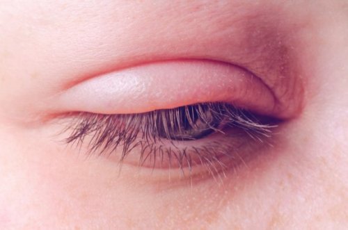 Blefarite: causas, sintomas e tratamento