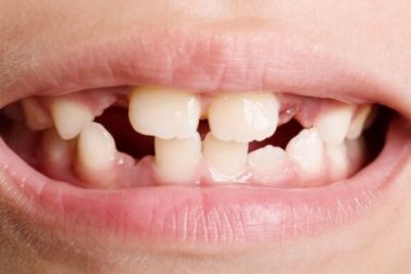 Agenesia dentária: tipos e tratamentos