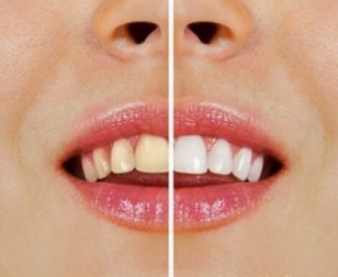 Produtos naturais para branquear os dentes
