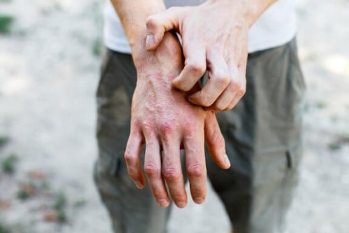 6 receitas caseiras para tratar a dermatite de contato