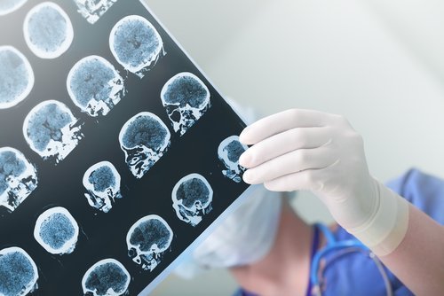 Diferenças entre demência senil e doença de Alzheimer na ressonância