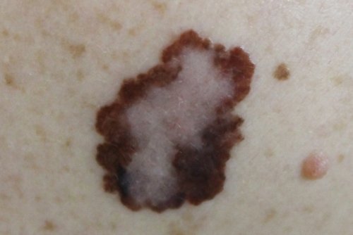 Forma de melanoma maligno
