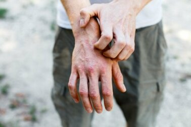 6 preparações caseiras para tratar a dermatite de contato
