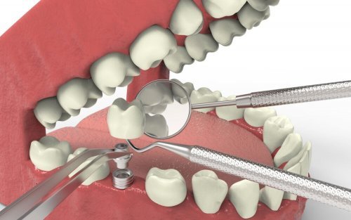 Implante dental ajudaa agenesia dentária