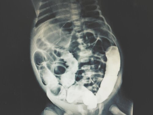 Imagem da lavagem peritoneal diagnóstica