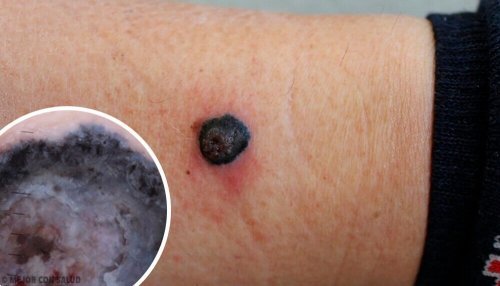 Melanoma maligno: causas e diagnóstico