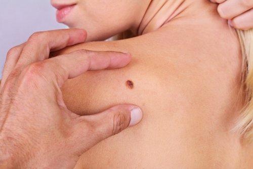 O melanoma maligno muda de tamanho