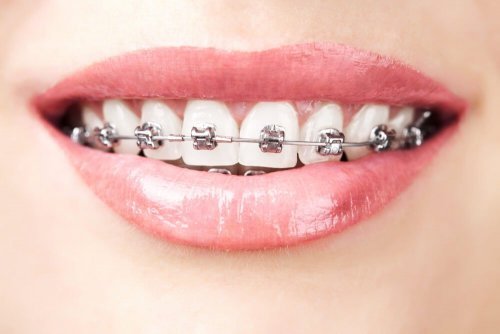 Ortodontia contra agenesia dentária