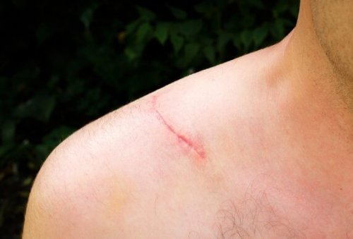 Cremes naturais para atenuar as cicatrizes