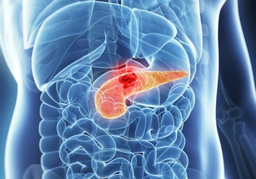 Localização do câncer de pâncreas