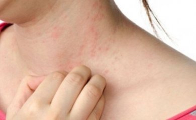 Urticária: como acalmá-la com remédios naturais