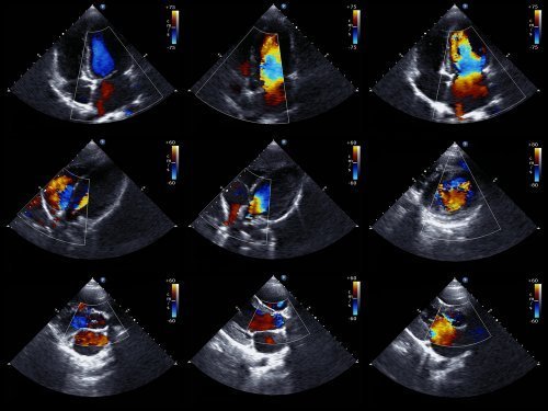 Ecocardiograma
