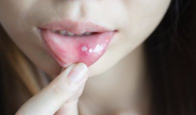 Como tratar aftas e feridas na boca?