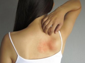 Remédios de uso externo para aliviar a brotoeja
