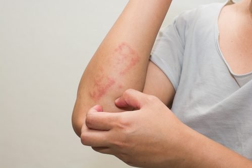 Homem com brotos de psoríase coçando o braço