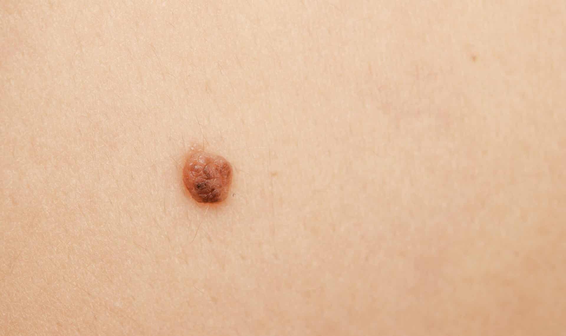 O que é o teste ABCDE na dermatologia?