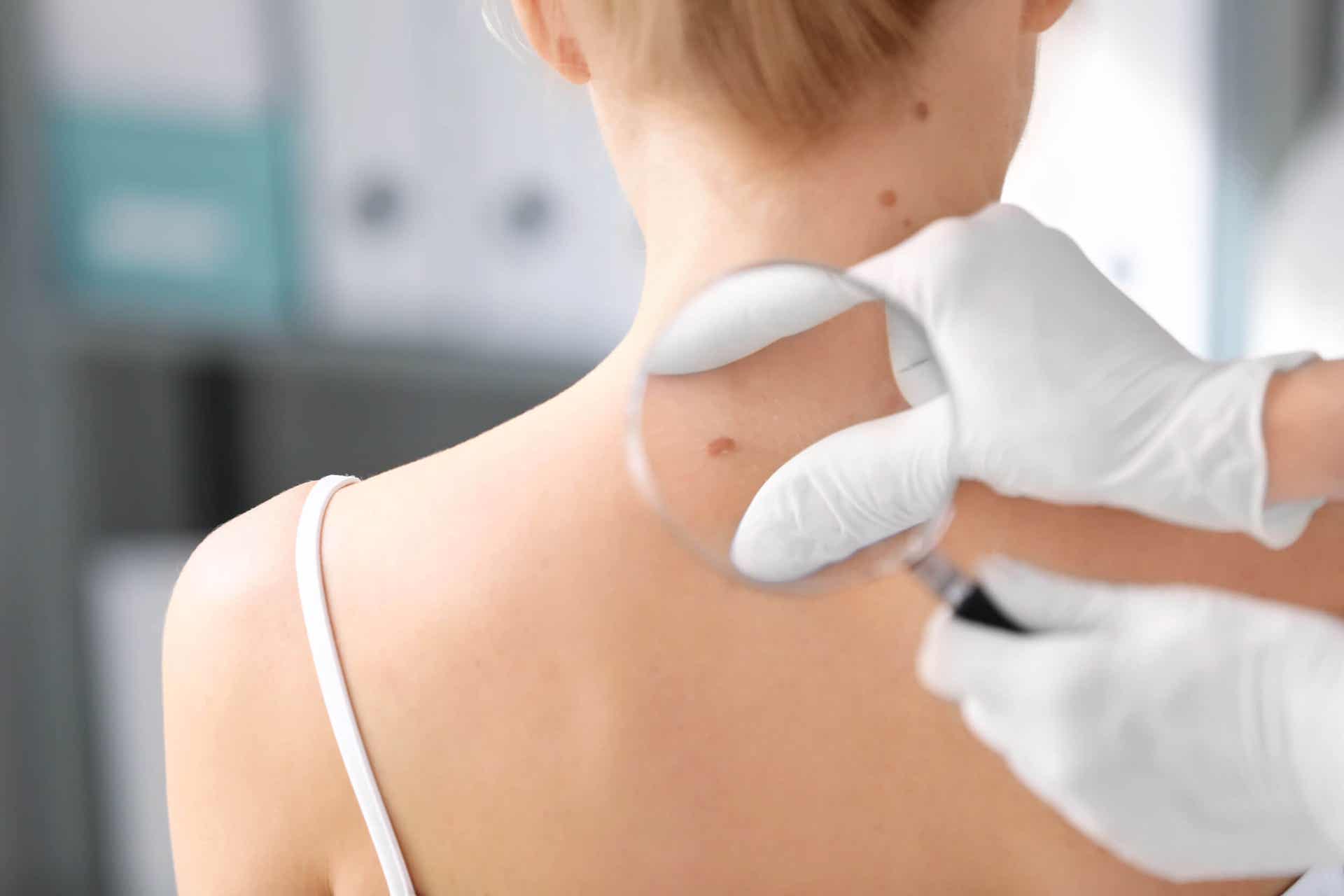O que é o teste ABCDE na dermatologia?