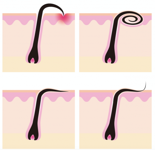 Encravamento do pelo