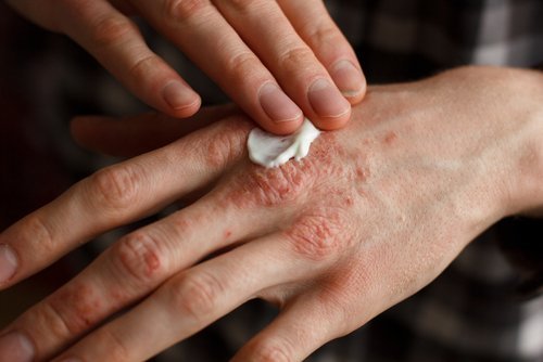 Para tratar os brotos da psoríase é preciso proteger a pele